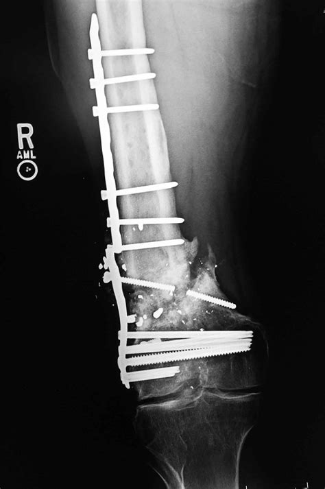 Broken femur types, causes, treatment, recovery time & complications