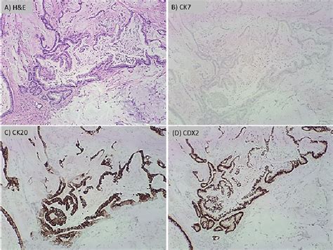 Panel A is H&E at 40x showing mucinous adenocarcinoma. The ...