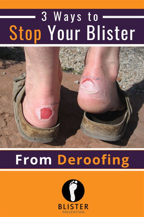 Deroofed Blisters: Here's What You Need To Know | Heel blisters, How to ...