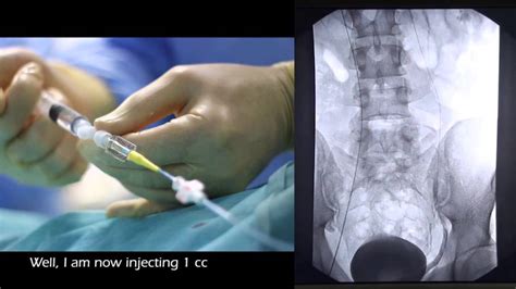 Embolization of varicocele- 2 more treatments - YouTube