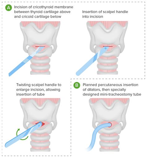 Tracheostomy Procedure Steps