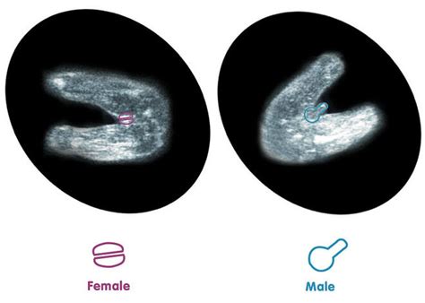 How to 'predict' baby's gender from an early ultrasound