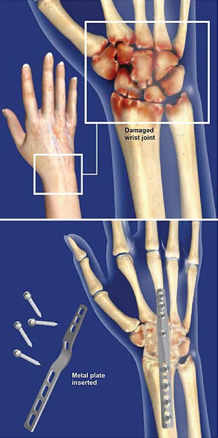 Wrist Fusion (Total Wrist Arthrodesis) | Central Coast Orthopedic ...