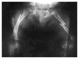 Bilateral Femur Fractures | NEJM