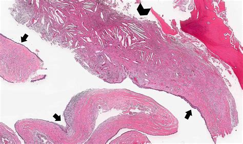 Dentigerous Cyst Histology