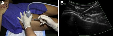 Ultrasound-Guided Intra-Articular Injection of the Hip: The Nashville ...