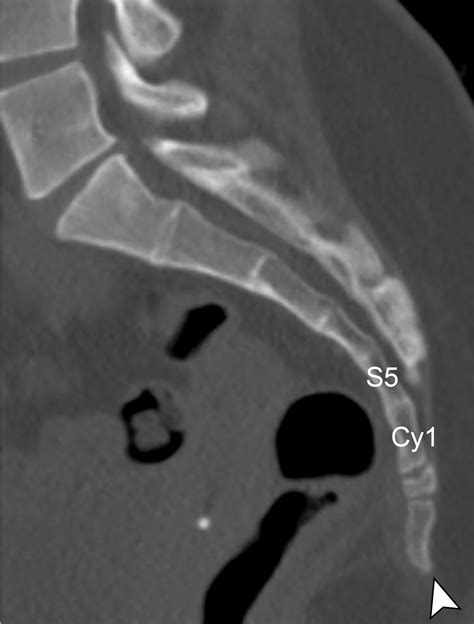 Imaging Coccygeal Trauma and Coccydynia | RadioGraphics