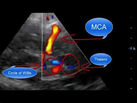 Transcranial Doppler Point of Care Ultrasound - YouTube