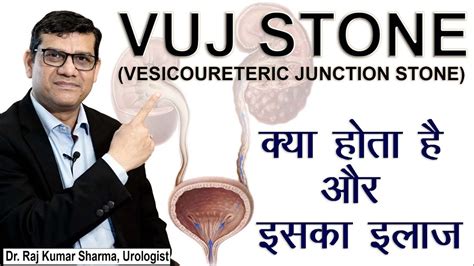 VUJ STONE (vesicoureteric junction stone) || Dr. Raj Kumar Sharma ...