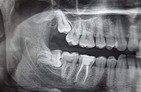 My impacted wisdom tooth X-ray. : r/mildlyinteresting