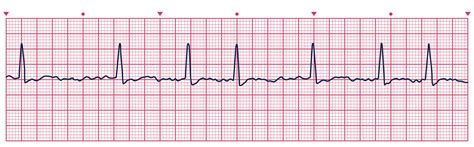 UNC MEDIA | Heart Rhythms Quiz