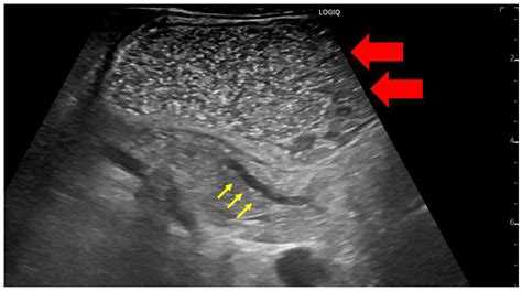 Pancreatic Duct Ultrasound