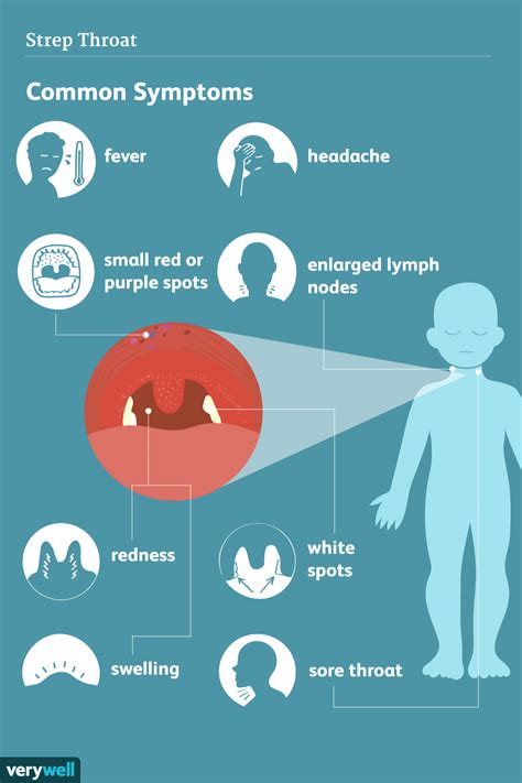 Strep Throat: Signs, Symptoms, and Complications (2022)