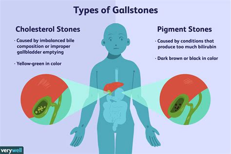 Weight Loss And Gallbladder Symptoms | Blog Dandk