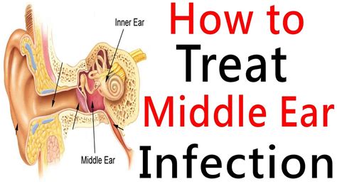 Middle Ear Infection & Middle Ear Effusion - Causes & Treatment