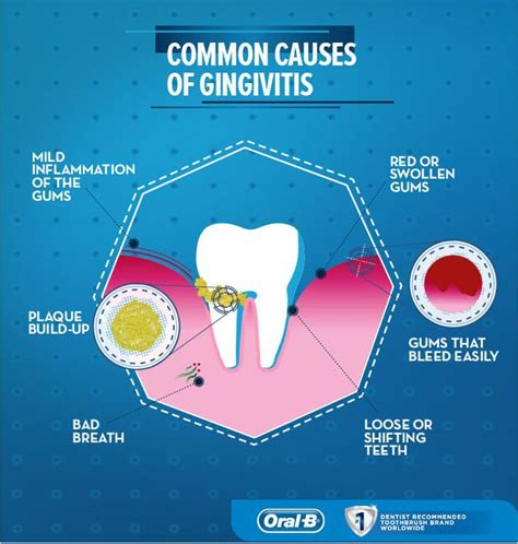 What is Gingivitis? Symptoms, Causes, and Treatments - Oral-B