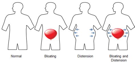 Understanding Bloating and Distension - IFFGD