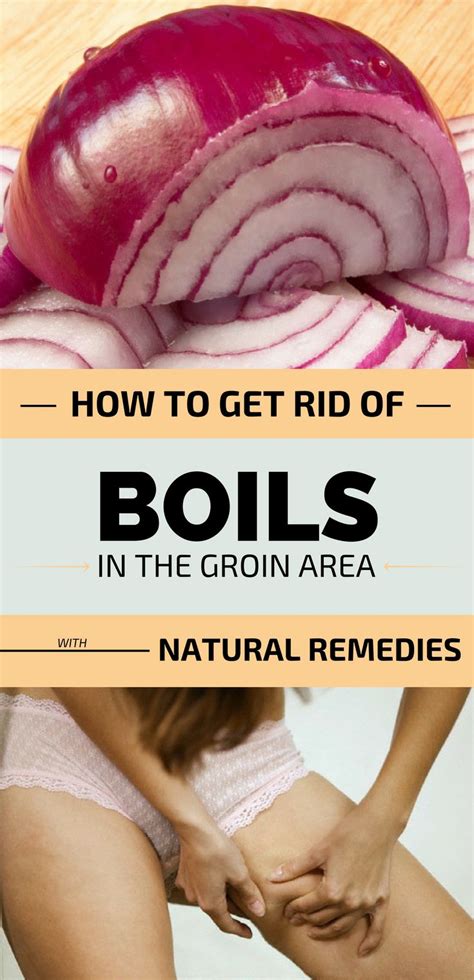 How To Get Rid Of Boils In The Groin Area With Natural Remedies | Get ...