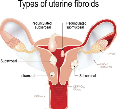 Uterine Fibroids: Symptoms, Causes, Diagnosis, Treatment