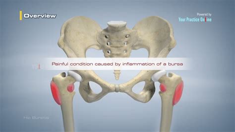 Hip Bursitis Video | Hip Orthopaedics Videos | Your Practice Online ...