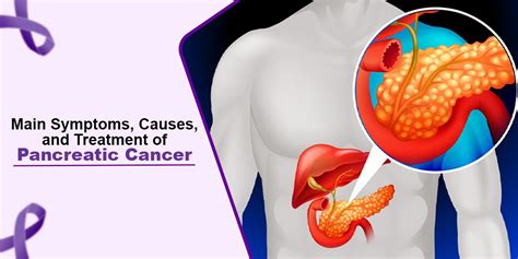 Main Symptoms, Causes, and Treatment of Pancreatic Cancer