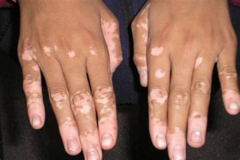 Vitiligo: Causes, Symptoms and Treatments – From Doctor