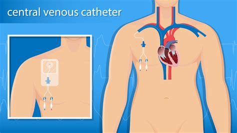 What are the types of Central Venous Catheters? | Vascular Wellness