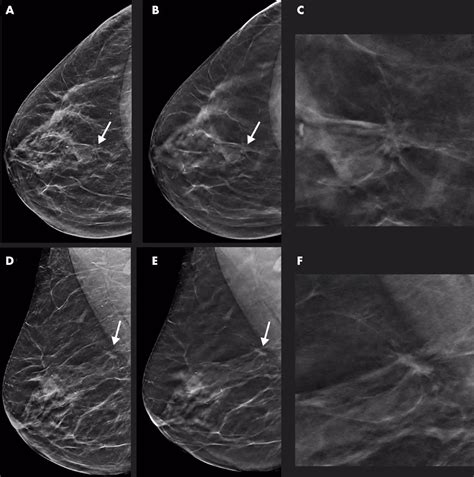 DBT helps in early detection of breast cancer compared to mammography ...