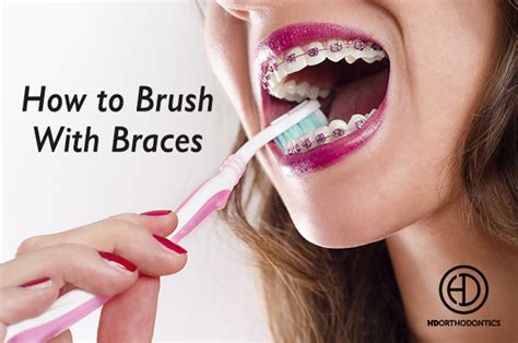 Tips For Brushing Your Teeth While Wearing Braces