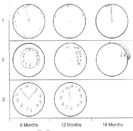 Examples of clock drawings showing deterioration in dementia, adopted ...