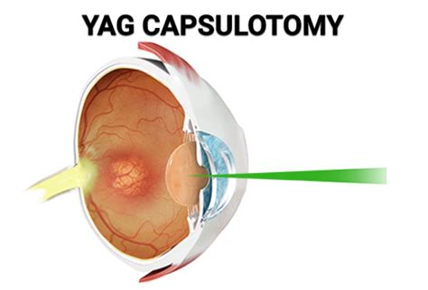 YAG Capsulotomy (YAG Laser Eye Surgery) - Vitreous Retina Macula ...