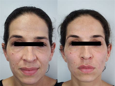 Juvederm Cheeks Before And After Photos