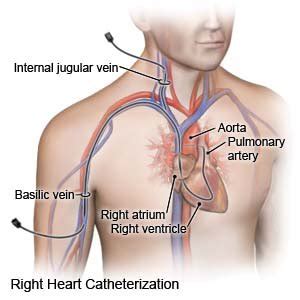 Right Heart Catheterization - What You Need to Know