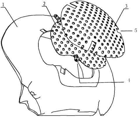 Double-layer titanium mesh for cranioplasty - Eureka | Patsnap develop ...