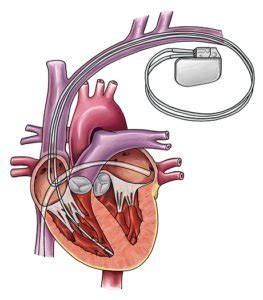 Implantable Cardioverter Defibrillator (ICD) | Pacemaker Surgery - HTW