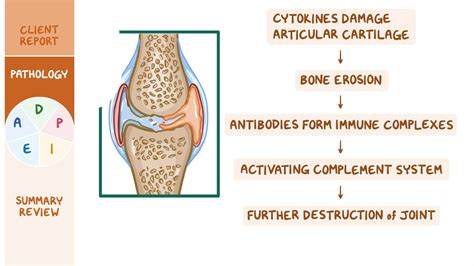 Rheumatoid arthritis (RA): Nursing process (ADPIE) - Osmosis Video Library