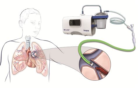 Insera Announces Successful First-in-Human Treatment of Patient With ...