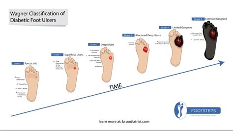 Diabetic Foot Ulcer - Footsteps Foot Clinic - Footsteps Foot Clinic