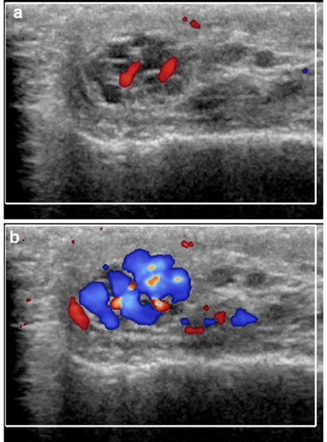 Sarteschi's grade I varicocele. Colour Doppler images obtained at rest ...