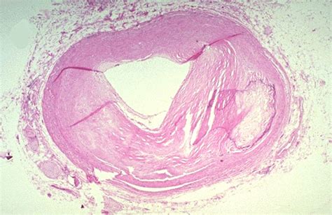 Coronary artery with atherosclerotic narrowing, microscopic picture ...