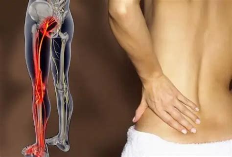 Sciatica. Symptoms, causes and treatment - Diseases and conditions 2023