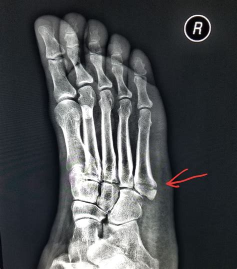 ปักพินในบอร์ด X-rays