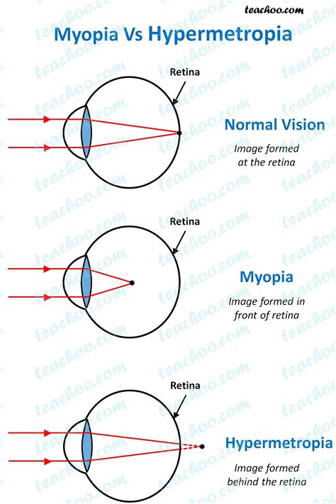 Difference Between Myopia and Hypermetropia Explain With Diagram ...