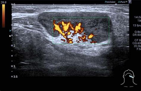 Ultrasound of a 30-year-old woman with cervical nodal enlargement shows ...