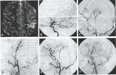 Surgical Management of Moyamoya Disease