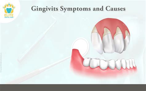 Gingivitis: Symptoms and Causes | Elite Dental Care