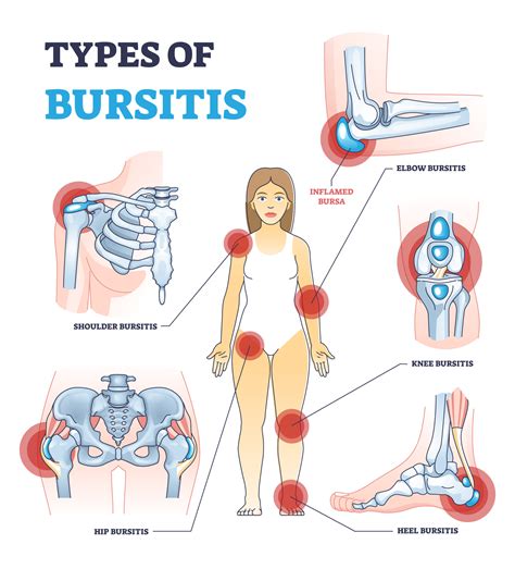 What is bursitis? - Bone & Joint