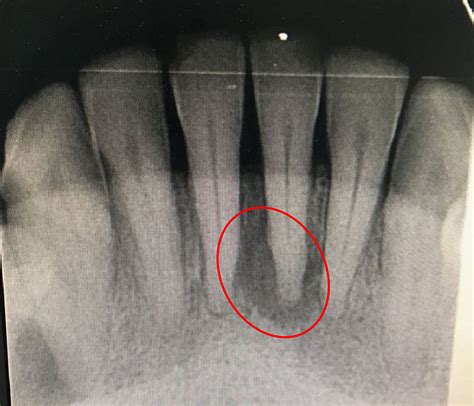 Cureus | Management of Acute Periodontal Abscess Mimicking Acute Apical ...