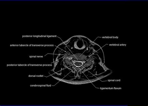 MRI spine anatomy | free MRI axial cervical spine anatomy | Mri ...