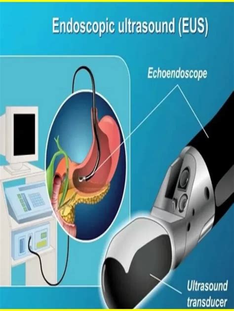 What is the Endoscopic Ultrasound: Best Procedure2023